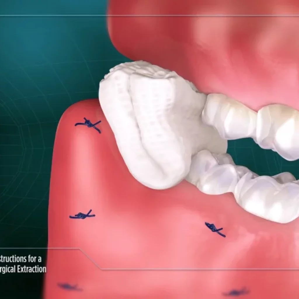 Tooth Extraction Procedure